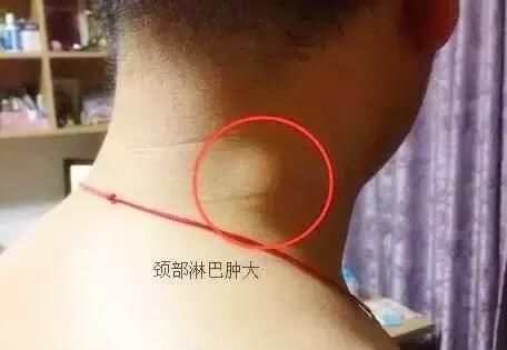 1,颈部淋巴